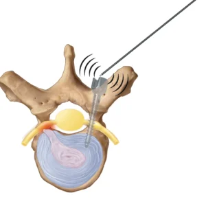 I-Stim Spine